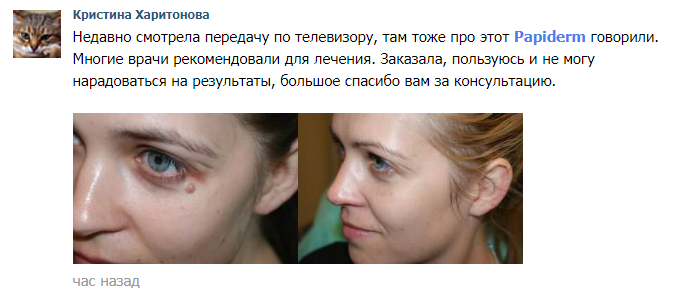 Средство Papiderm (Папидерм) от папиллом отзывы