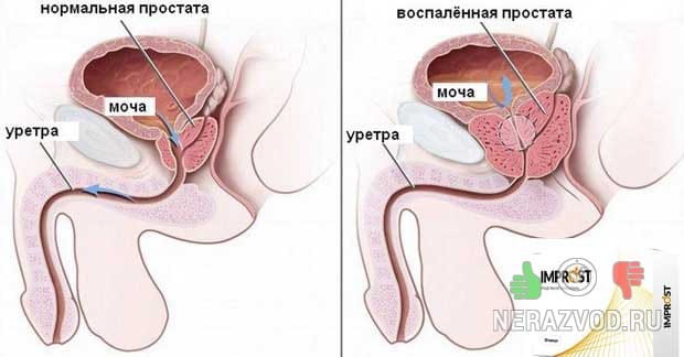 простатит у мужчин