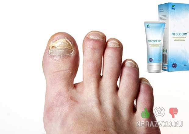 MICODERM ΠΎΡ Π³ΡΠΈΠ±ΠΊΠ° Π½ΠΎΠ³ ΠΈ Π½ΠΎΠ³ΡΠ΅ΠΉ