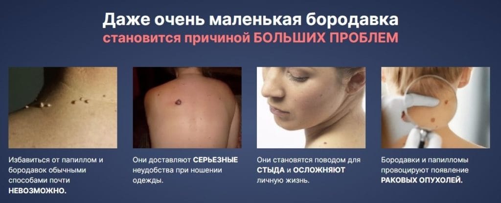 ΠΠ°ΠΏΠΈΠ΄Π΅ΡΠΌΠΈΠ½ ΠΎΡ ΠΏΠ°ΠΏΠΈΠ»Π»ΠΎΠΌ ΡΠ°Π·Π²ΠΎΠ΄ ΠΈΠ»ΠΈ ΠΏΡΠ°Π²Π΄Π°