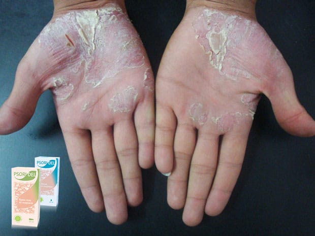 psoridel крем отзывы цена