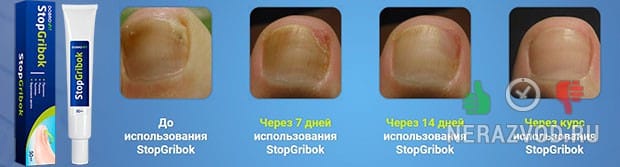 STOPGRIBOK ΠΎΡ Π³ΡΠΈΠ±ΠΊΠ° Π½ΠΎΠ³ΡΠ΅ΠΉ ΠΈ ΠΊΠΎΠΆΠΈ