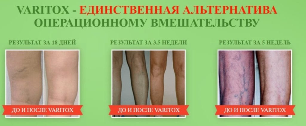 Крем-гель Варитокс (Varitox) от варикоза альтернатива