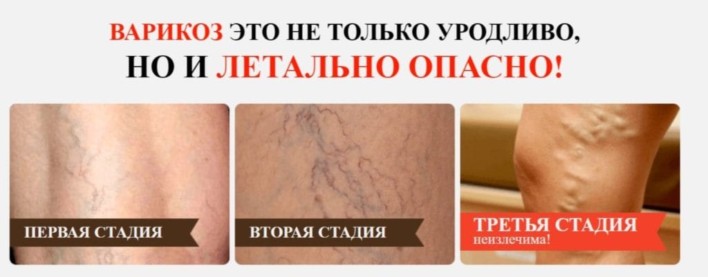 Крем Варитокс (Varitox) от варикоза